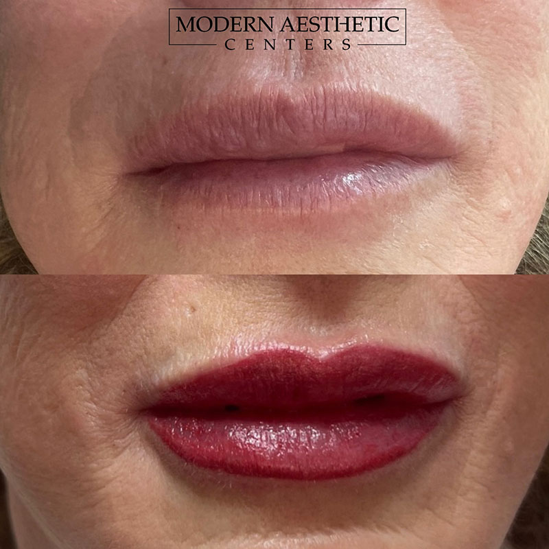 Lips Gallery Before & After Image