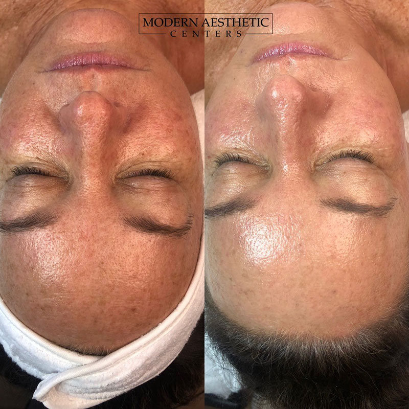 Facials Gallery Before & After Image