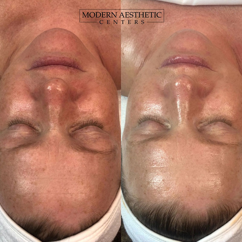 Facials Gallery Before & After Image