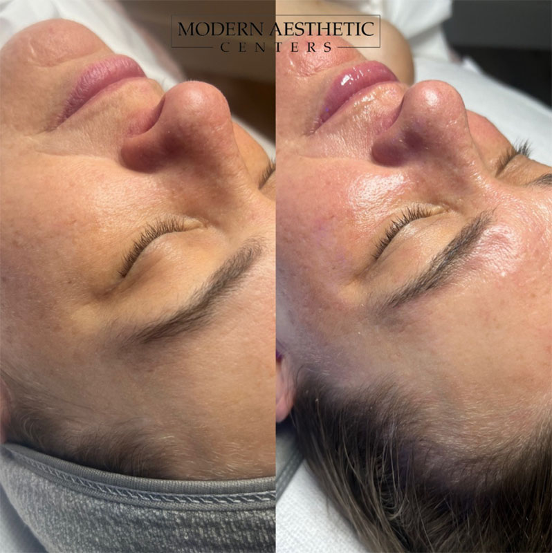 Facials Gallery Before & After Image