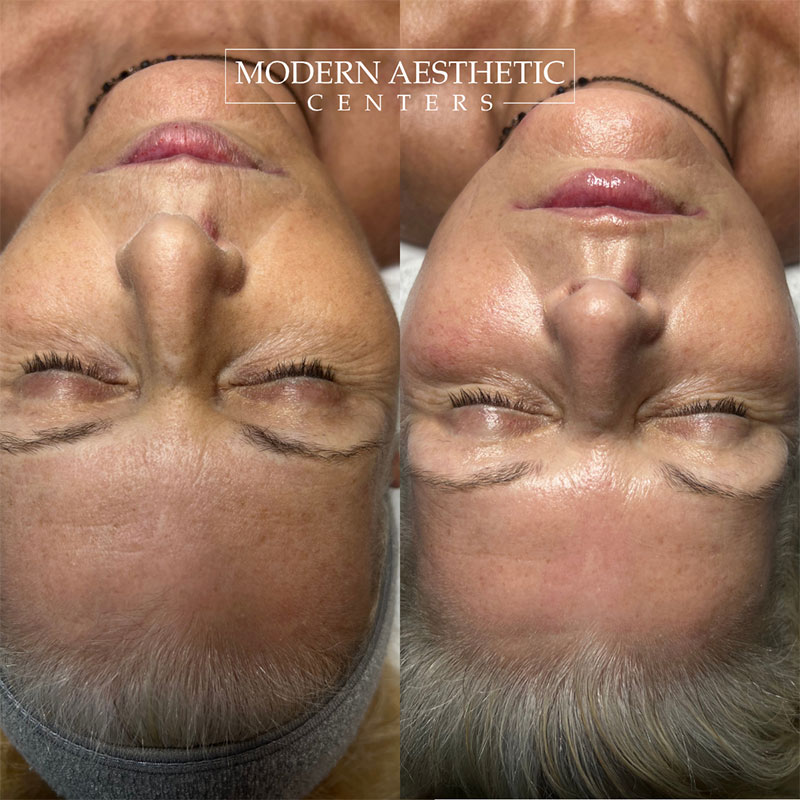 Facials Gallery Before & After Image