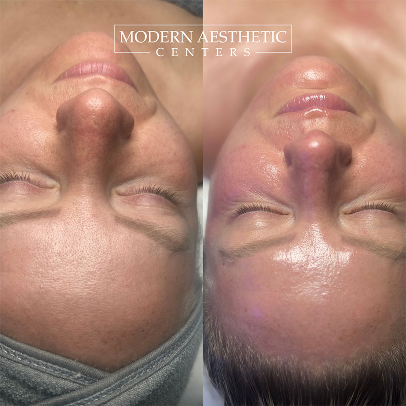 Facials Gallery Before & After Image