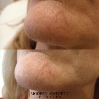 IPL Treatments Gallery Before & After Image