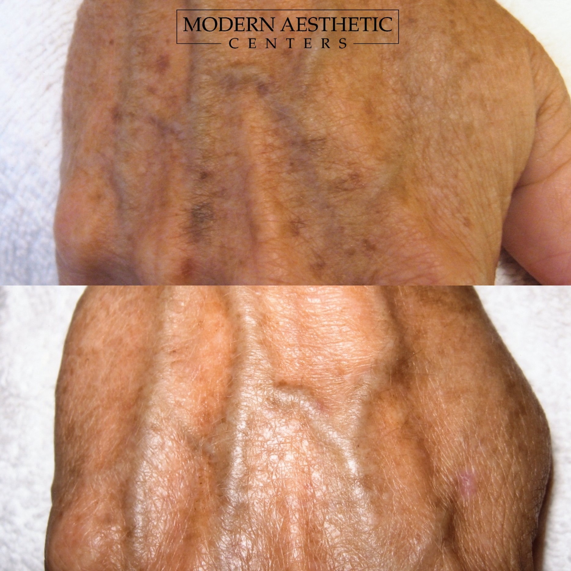 IPL Treatments Gallery Before & After Image