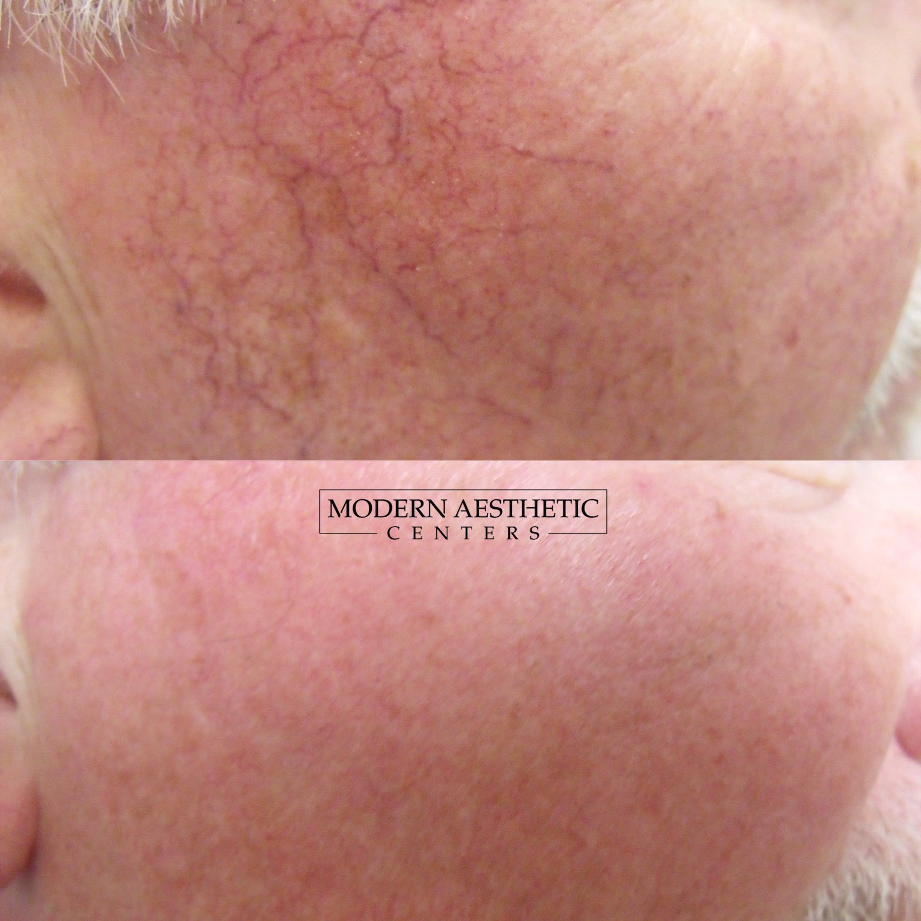 IPL Treatments Gallery Before & After Image