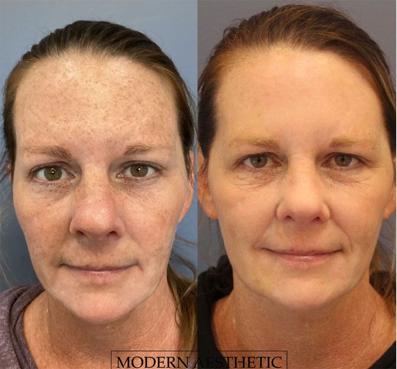 IPL Treatments Gallery Before & After Image