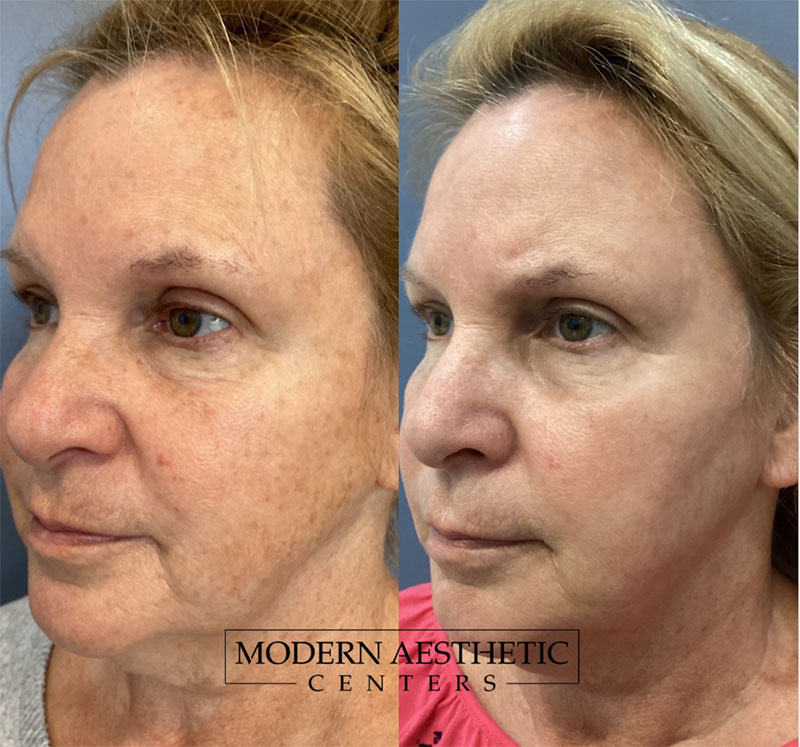 IPL Treatments Gallery Before & After Image