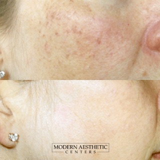 Laser Treatments Gallery Before & After Image
