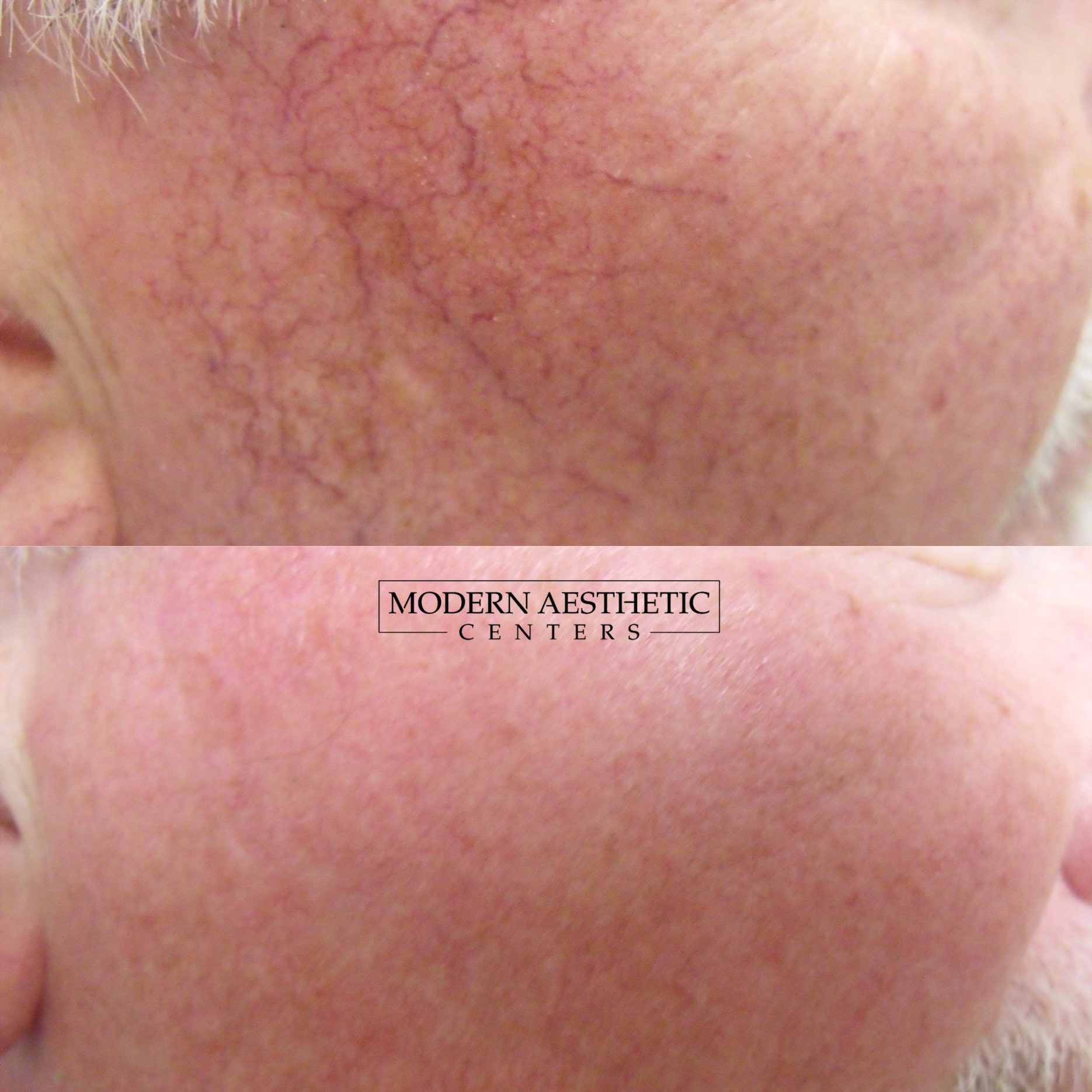 Laser Treatments Gallery Before & After Image