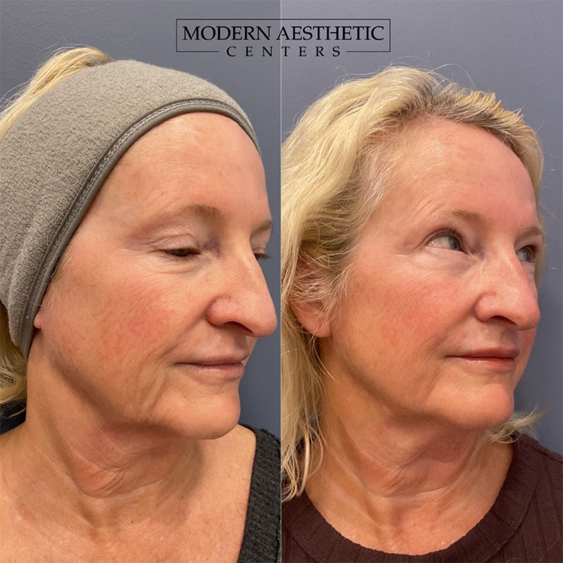 RF Microneedling Gallery Before & After Image