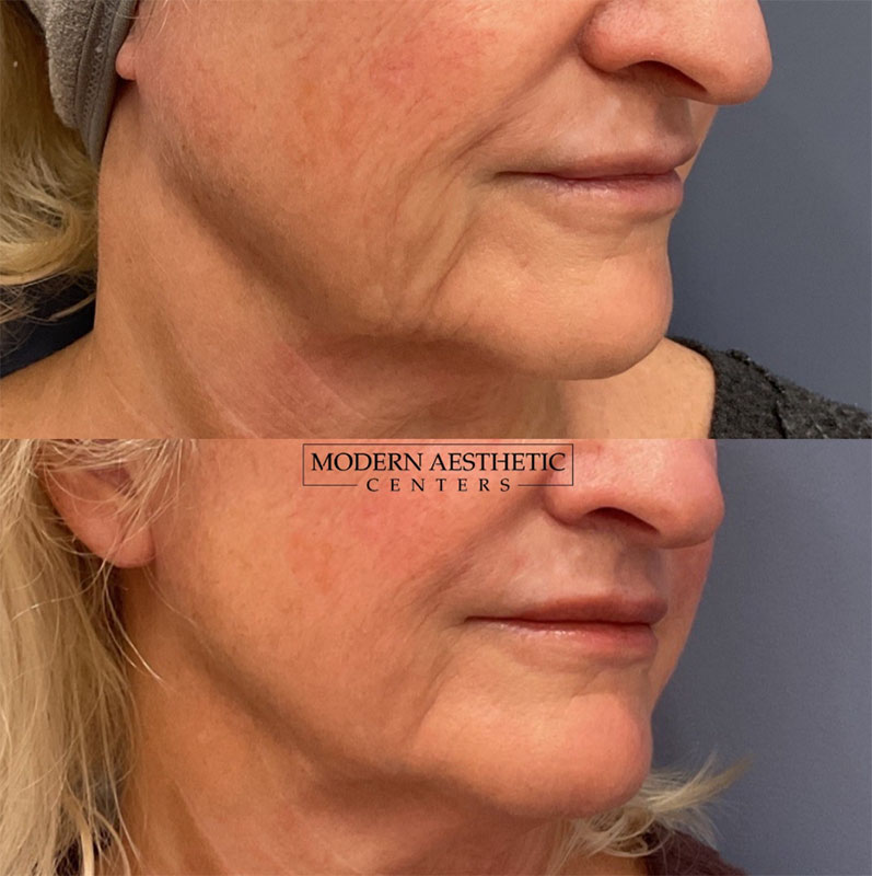 RF Microneedling Gallery Before & After Image