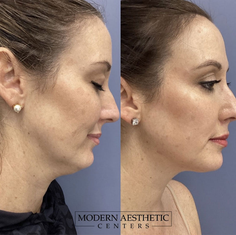 RF Microneedling Gallery Before & After Image