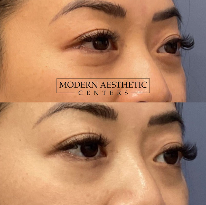 RF Microneedling Gallery Before & After Image