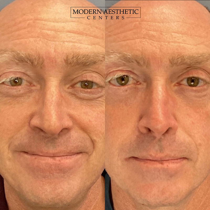 RF Microneedling Gallery Before & After Image