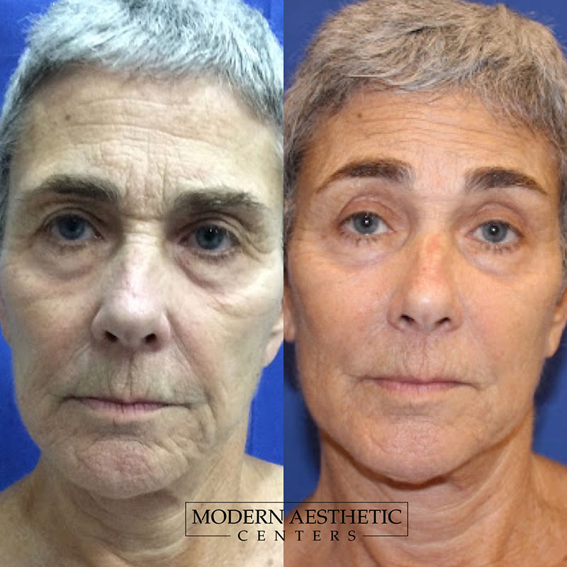 RF Microneedling Gallery Before & After Image