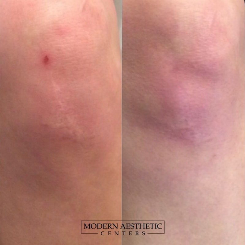 RF Microneedling Gallery Before & After Image